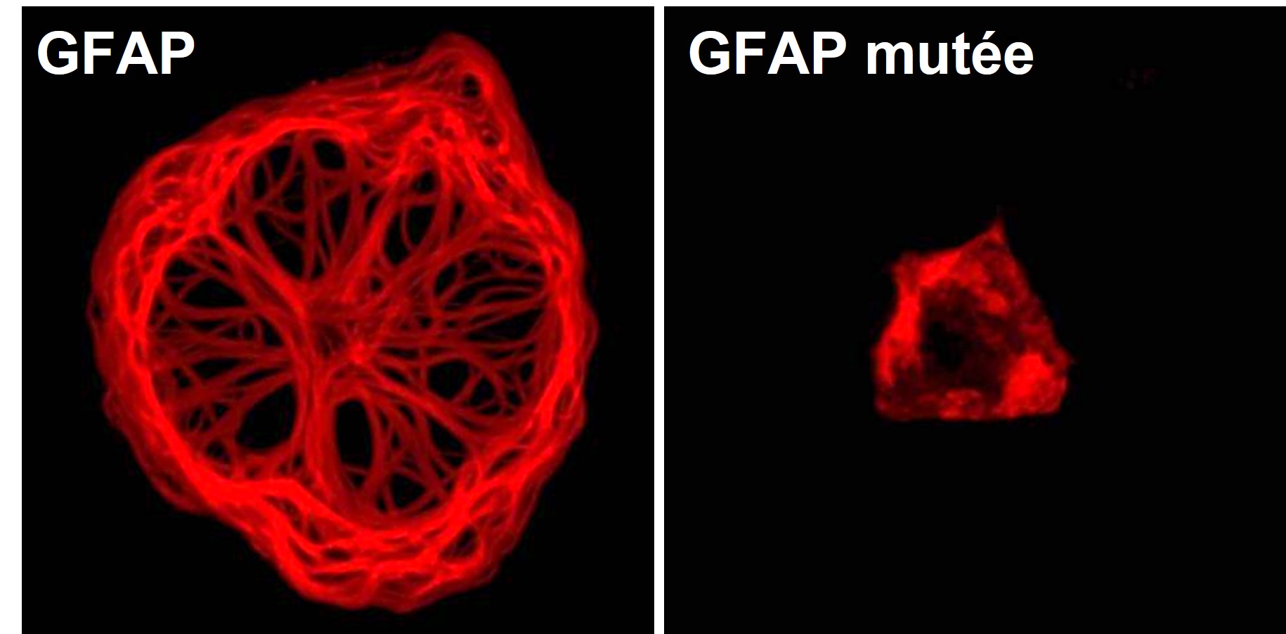 Protéine GFAP normale et mutée